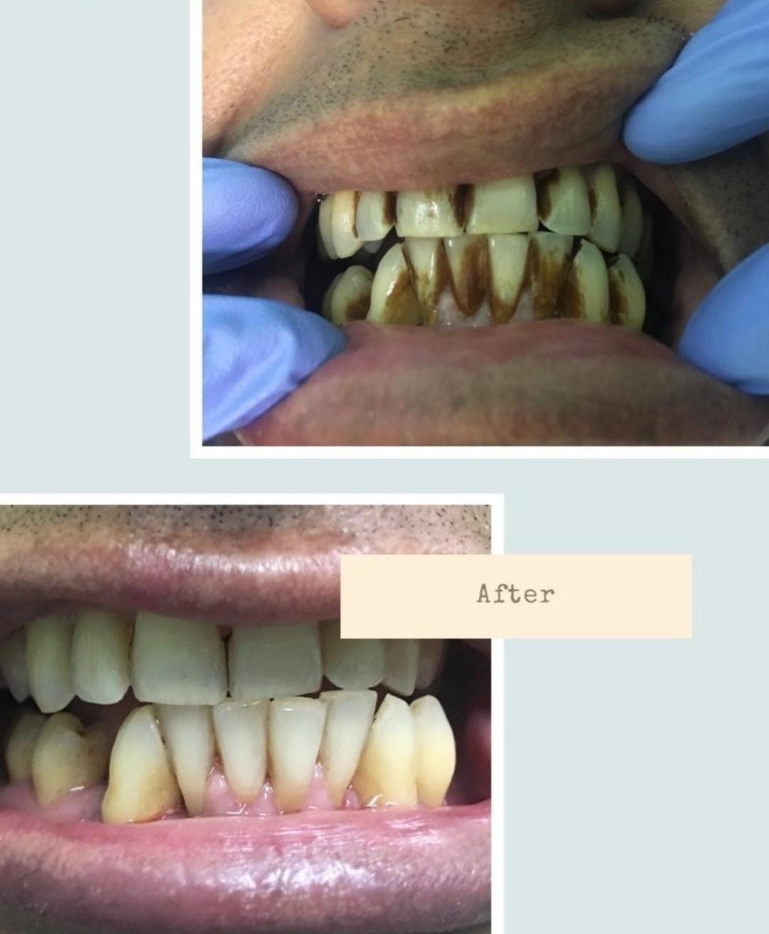 Before and after scaling and polishing