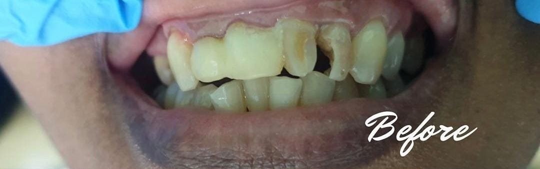 Before: damaged and missing front teeth