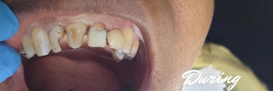 During: teeth prepared for restoration